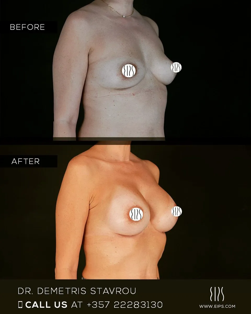 Breast Augmentation before and after