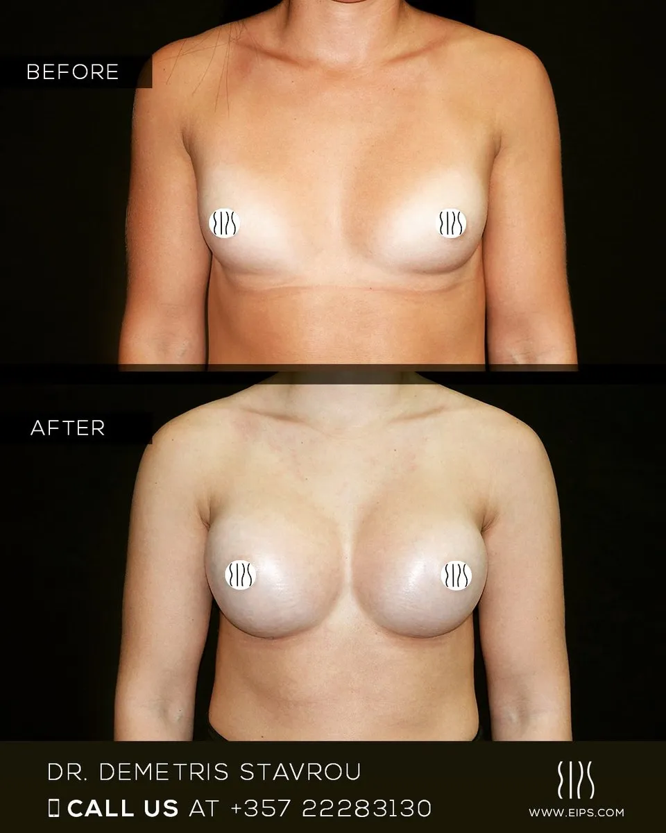 Breast Augmentation before and after