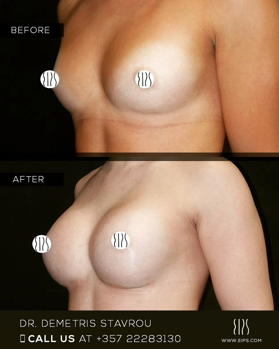 Breast Augmentation before and after