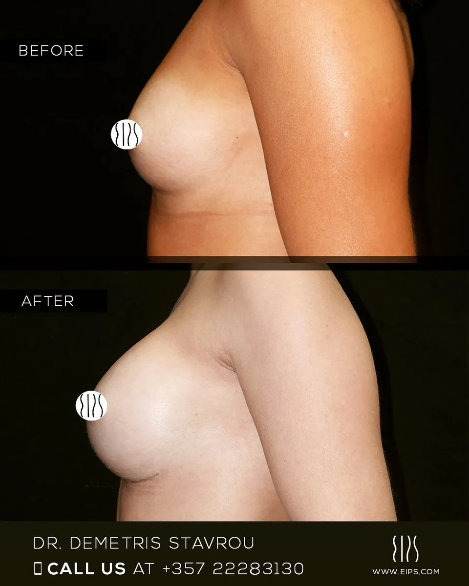 Breast Augmentation before and after
