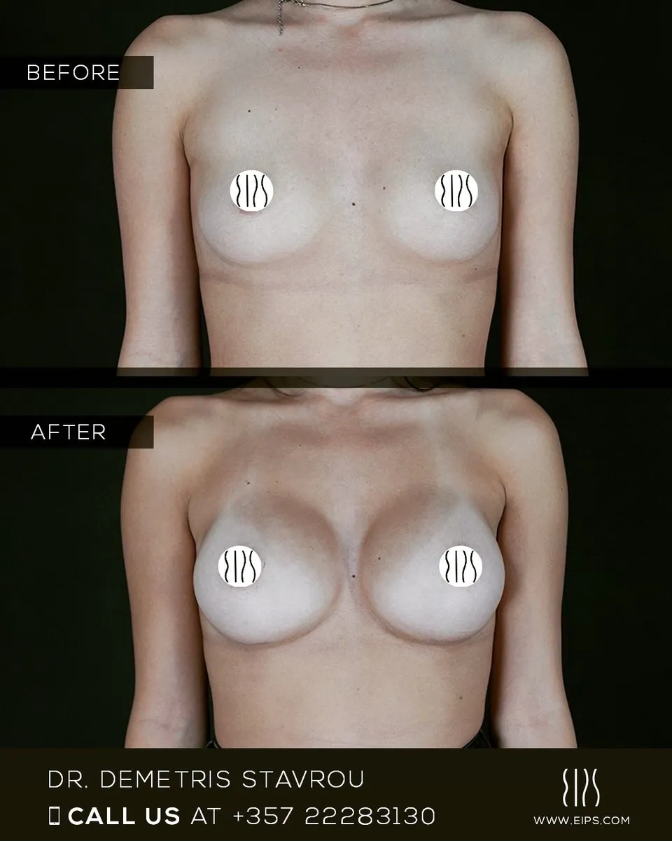 Breast Augmentation before and after