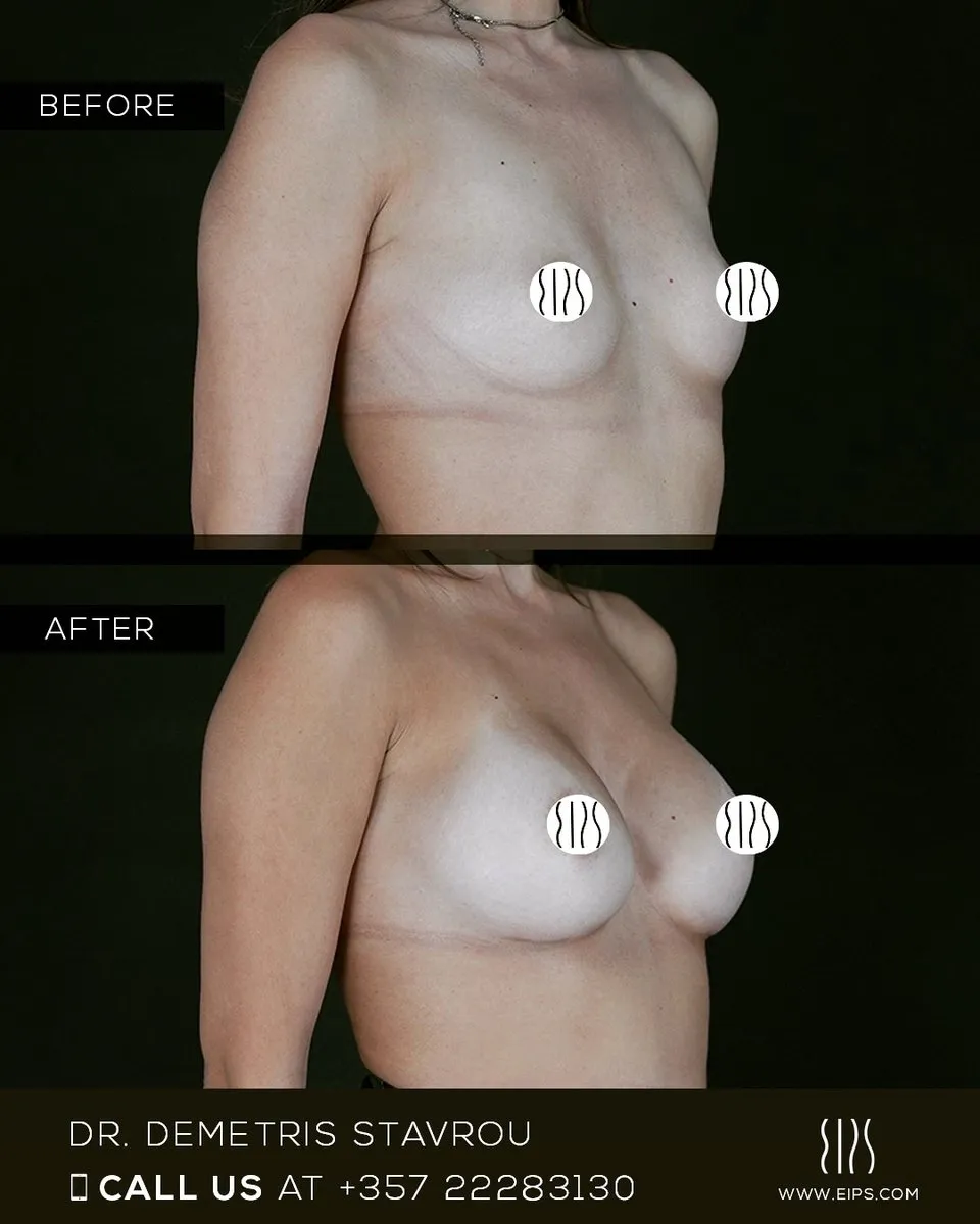 Breast Augmentation before and after