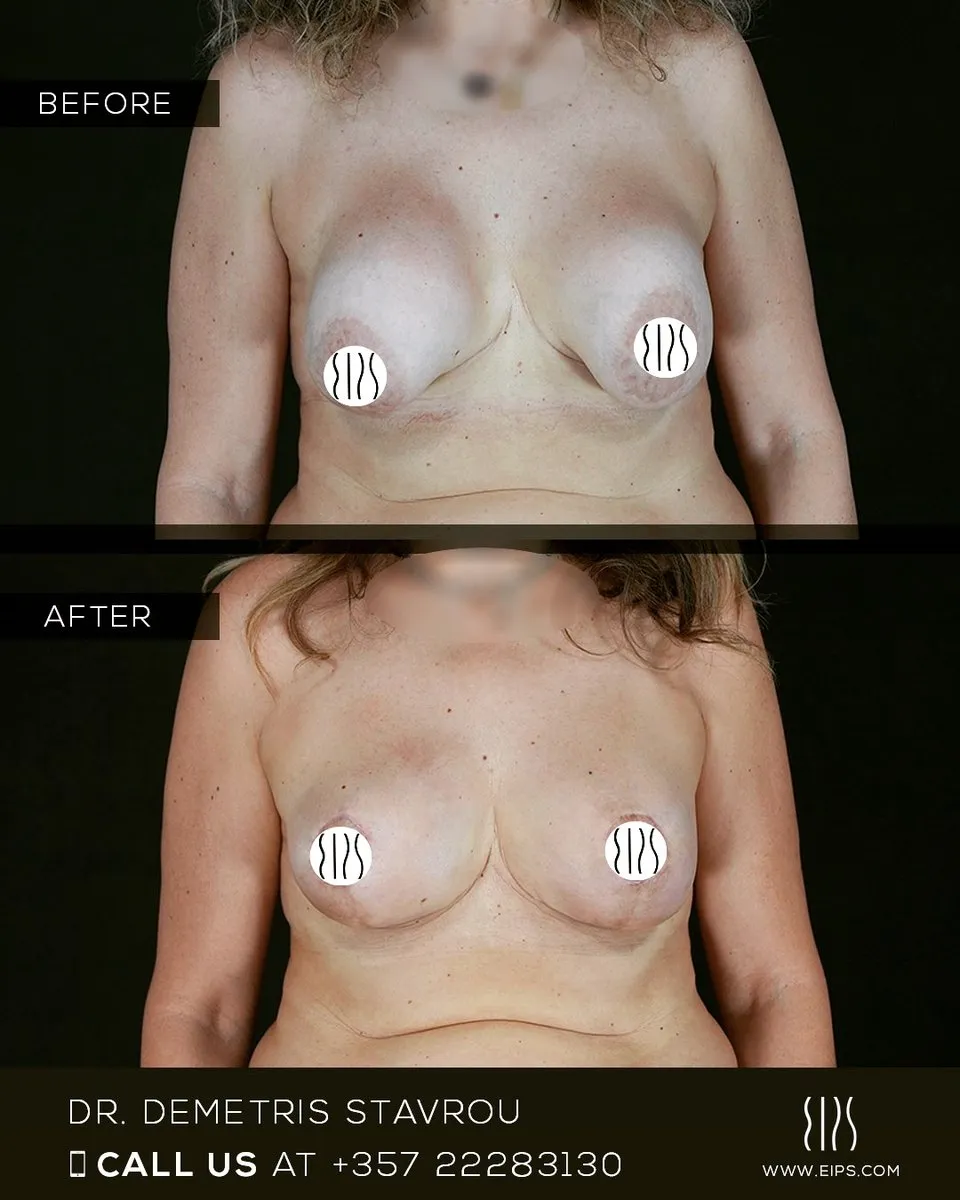Breast Augmentation before and after