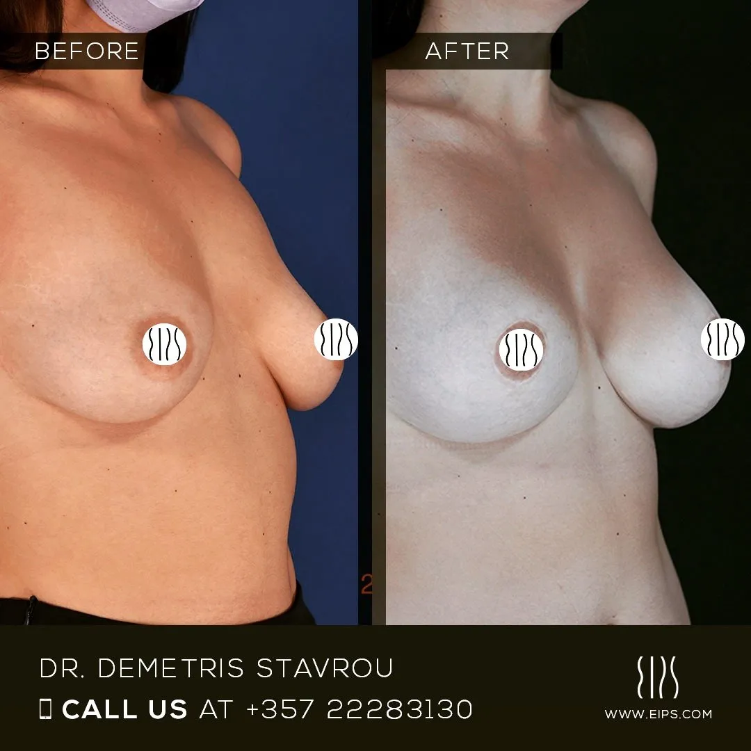 Breast Augmentation before and after
