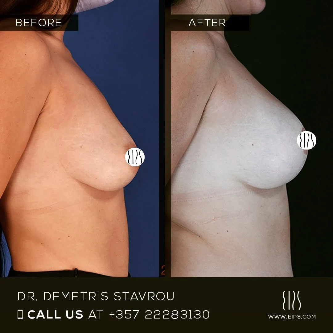 Breast Augmentation before and after