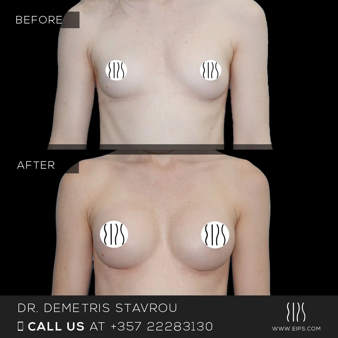 Breast Augmentation before and after