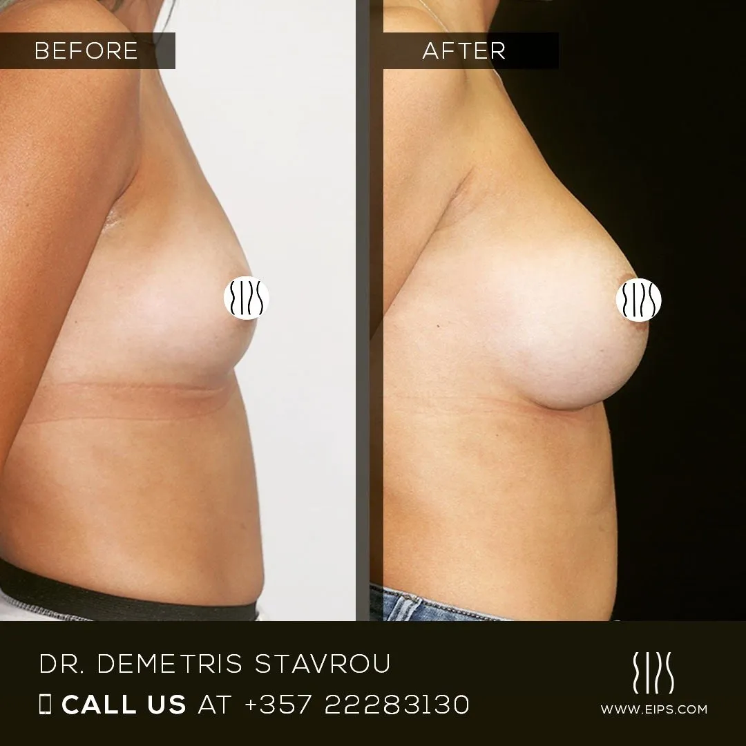 Breast Augmentation before and after