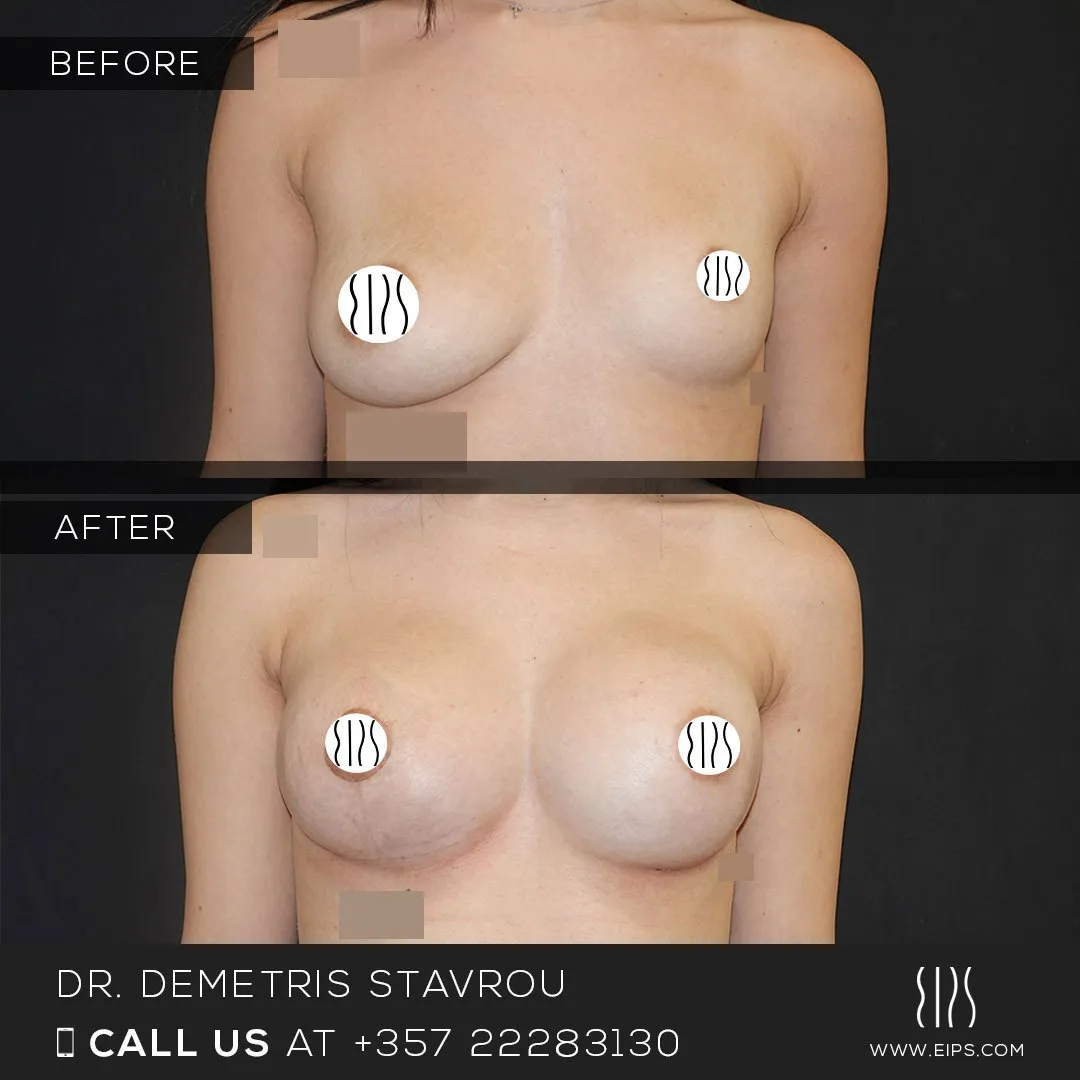 Breast Augmentation before and after