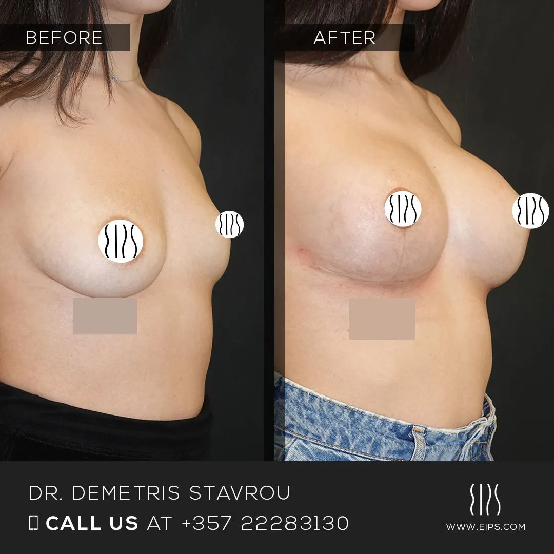 Breast Augmentation before and after