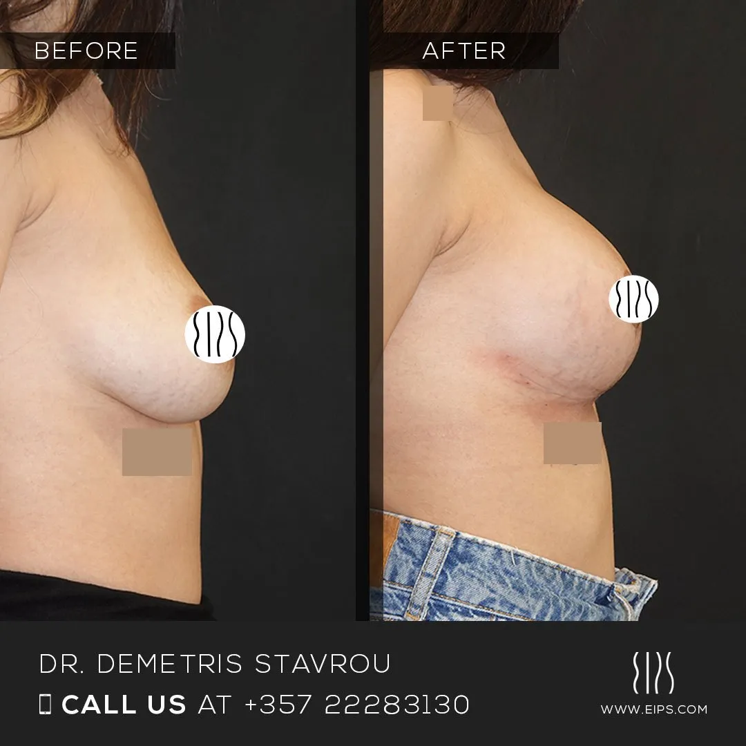 Breast Augmentation before and after