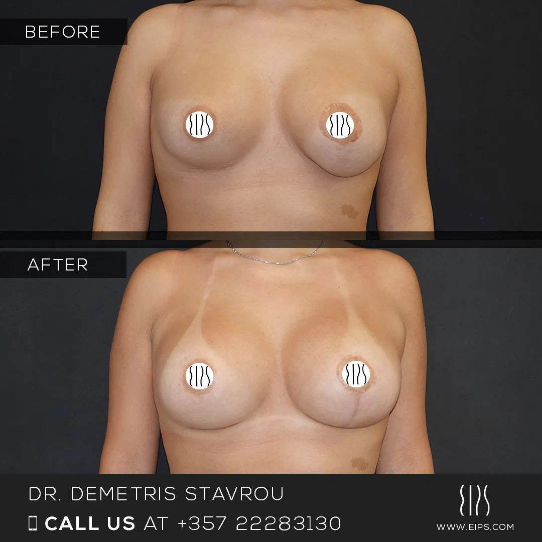 Breast Augmentation before and after