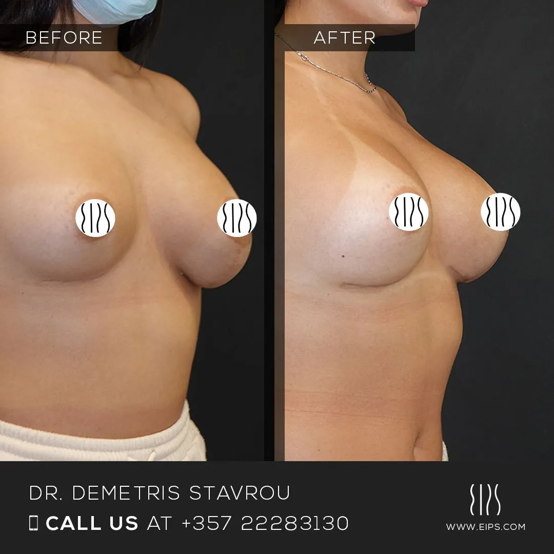 Breast Augmentation before and after
