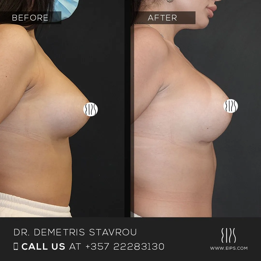 Breast Augmentation before and after