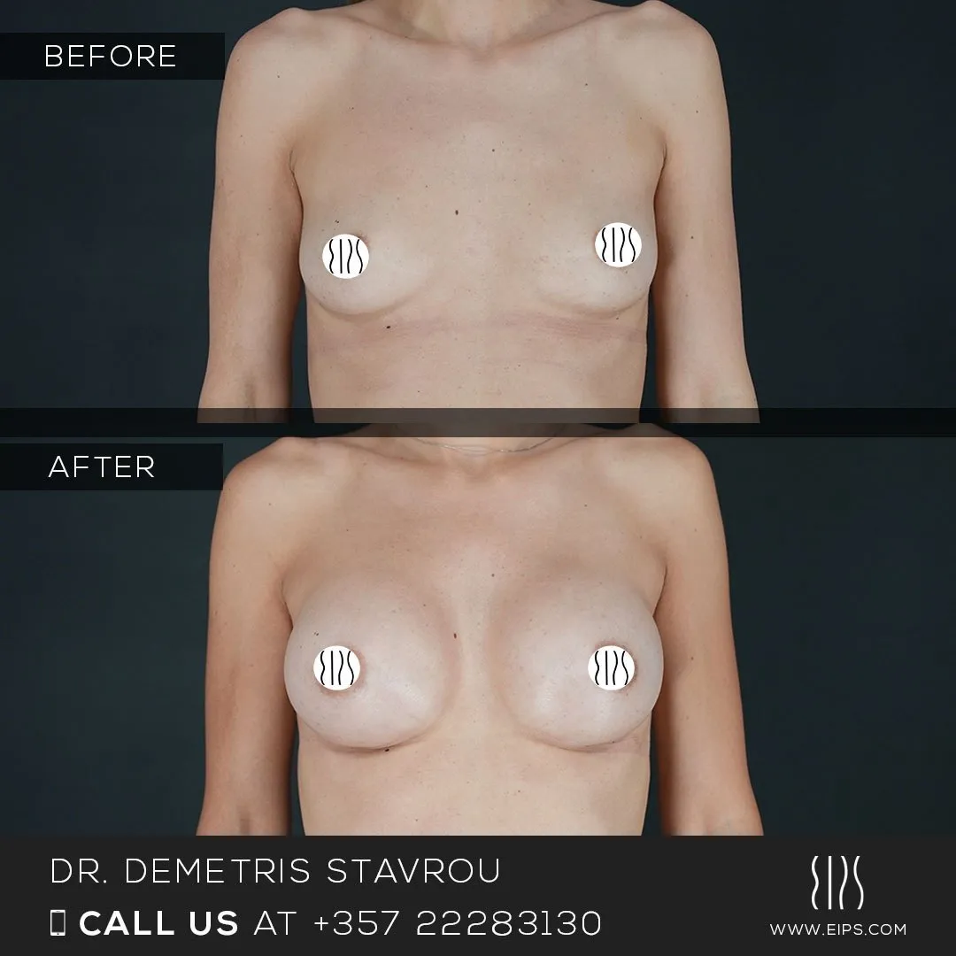 Breast Augmentation before and after