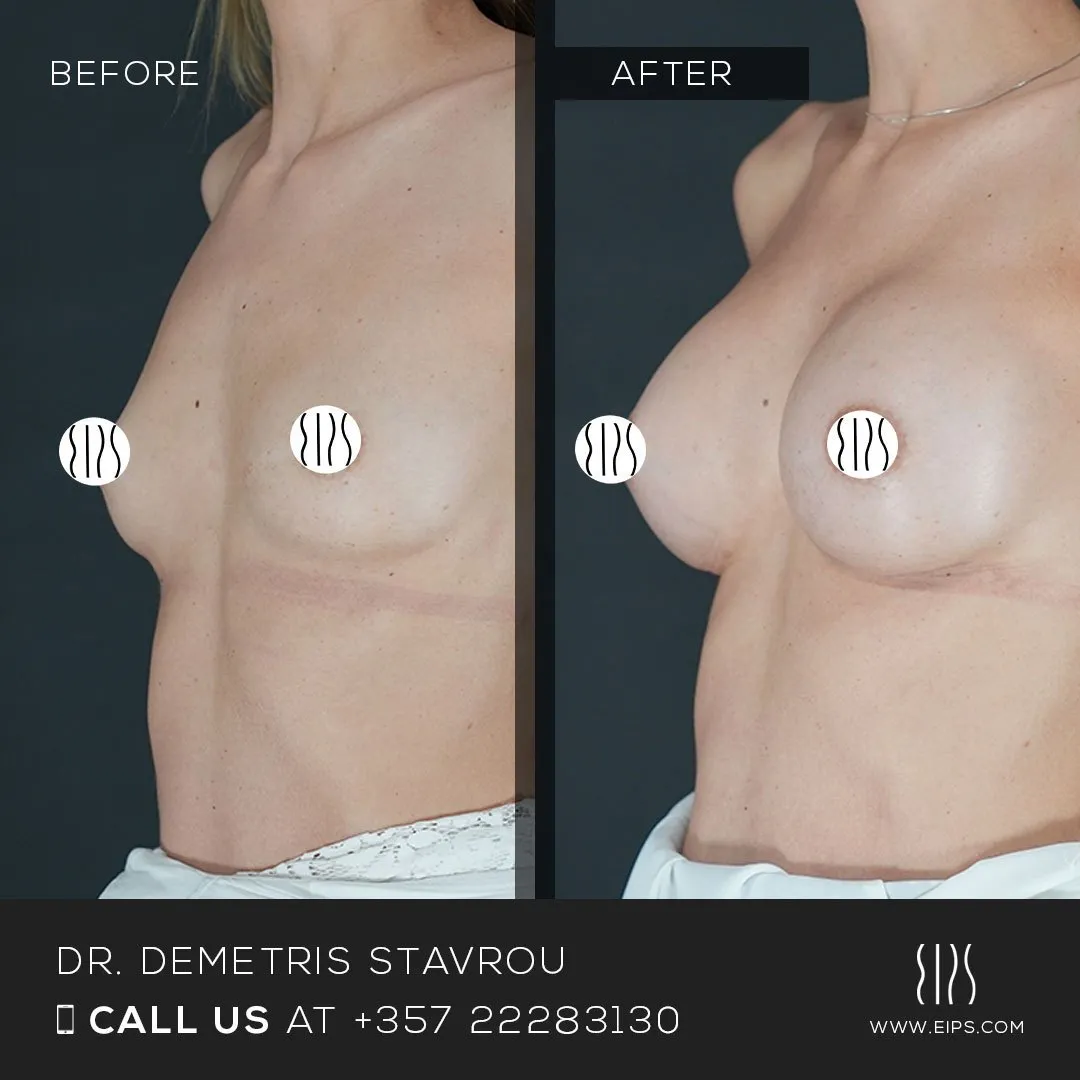 Breast Augmentation before and after