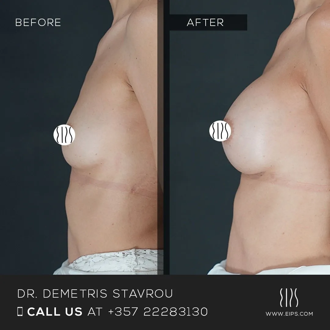 Breast Augmentation before and after