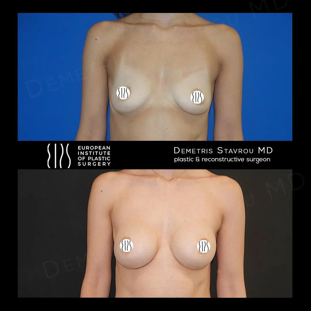 Breast Augmentation before and after