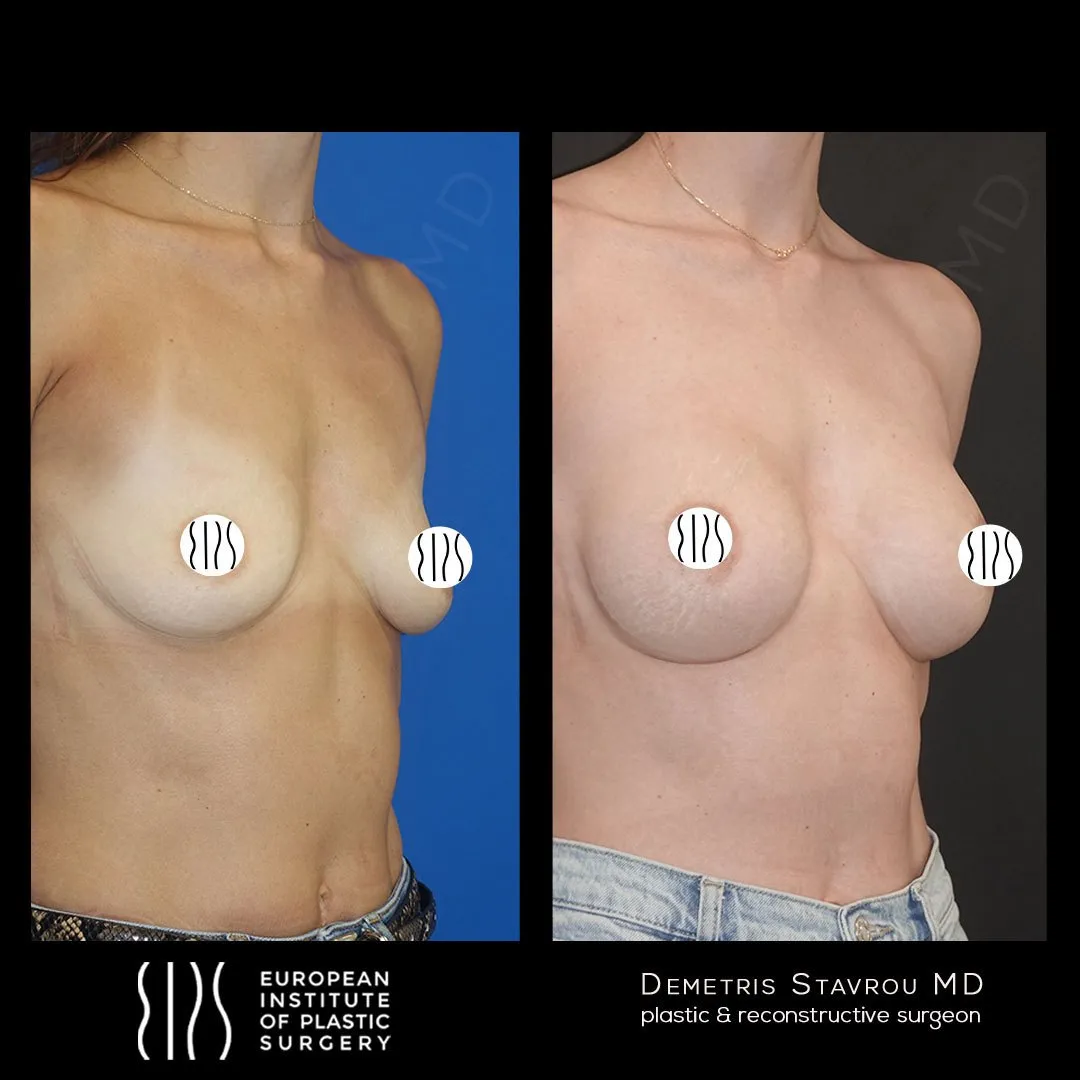 Breast Augmentation before and after