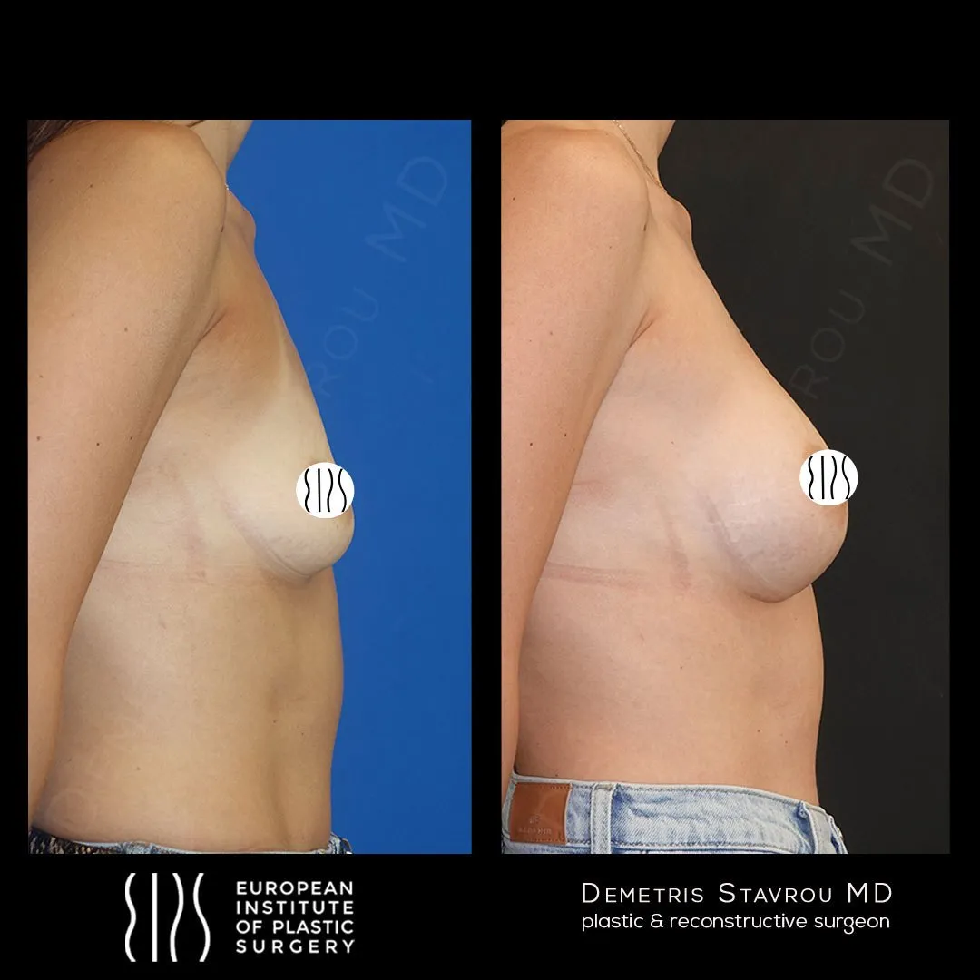 Breast Augmentation before and after