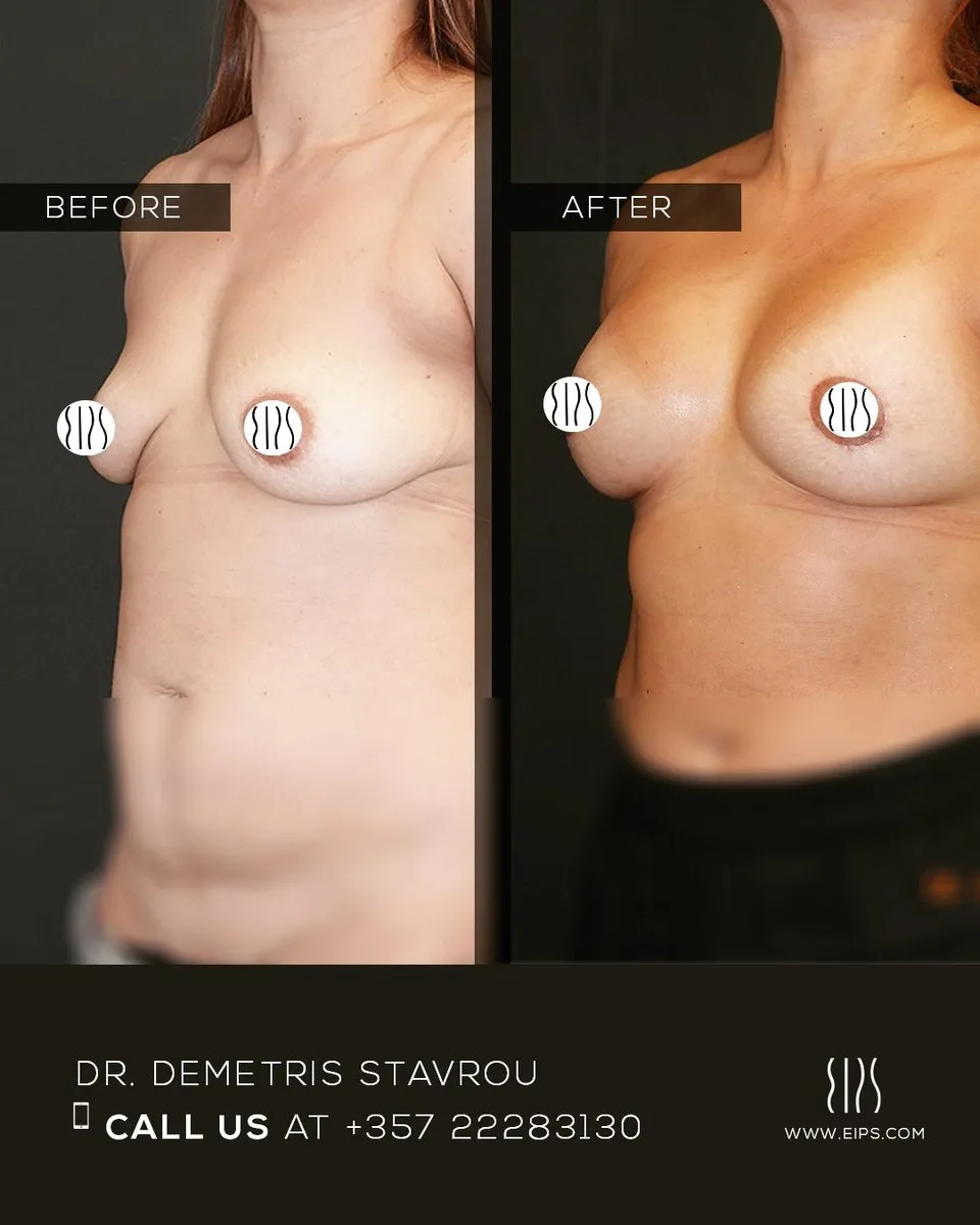 Breast Lift (Mastopexy) before and after