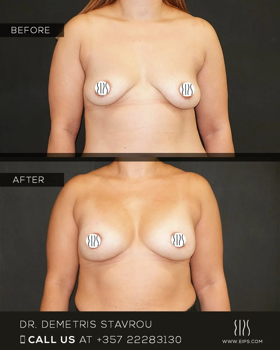 Breast Lift (Mastopexy) before and after