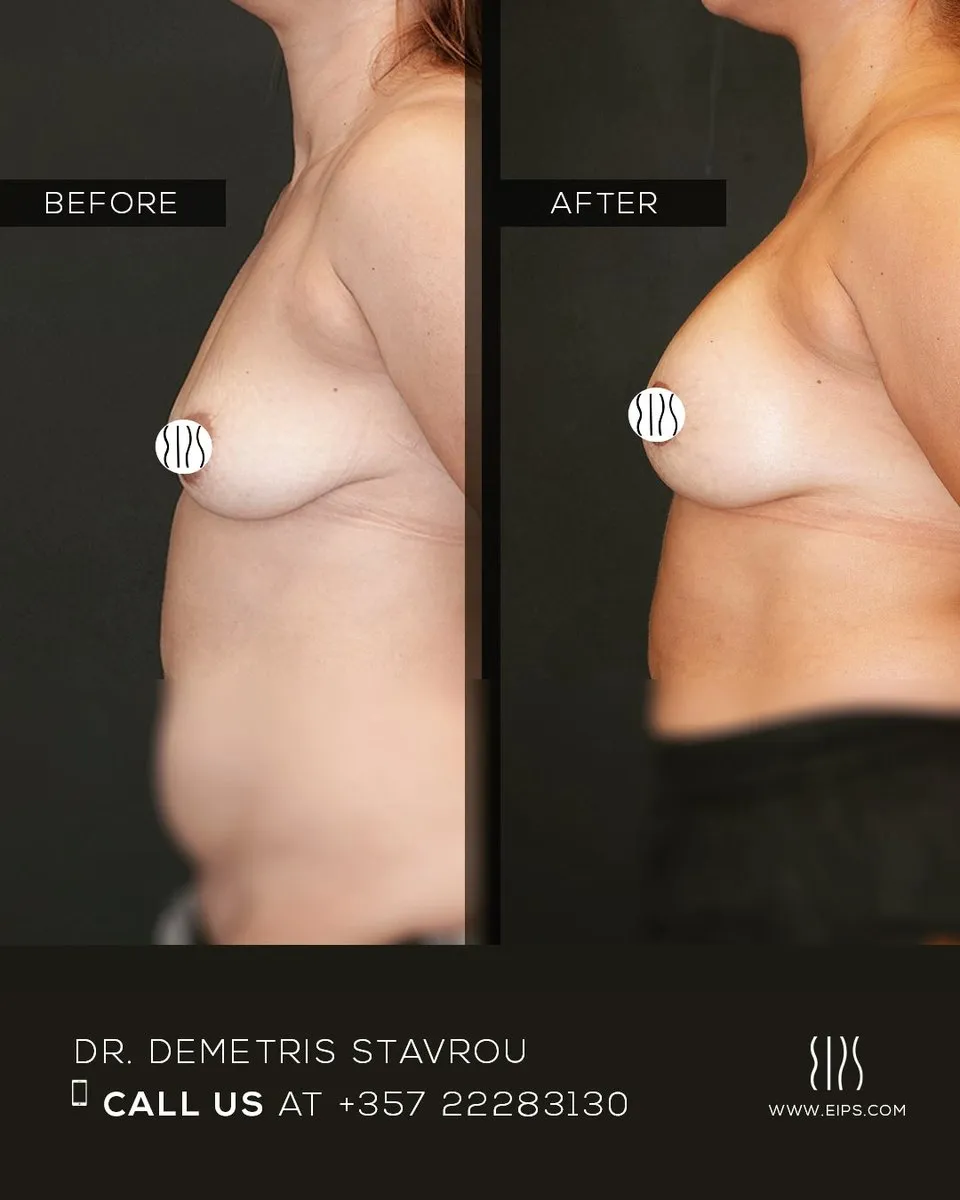 Breast Lift (Mastopexy) before and after