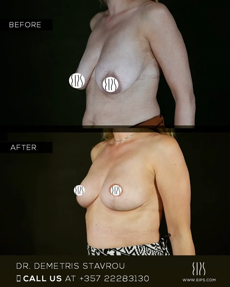 Breast Lift (Mastopexy) before and after