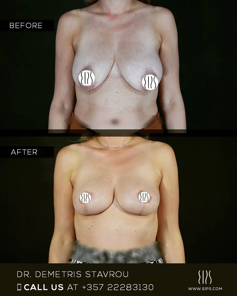 Breast Lift (Mastopexy) before and after