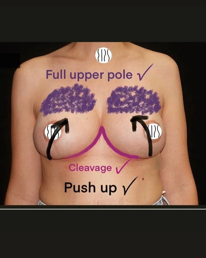 Breast Lift (Mastopexy) before and after