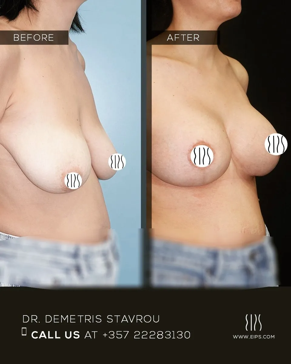 Breast Lift (Mastopexy) before and after