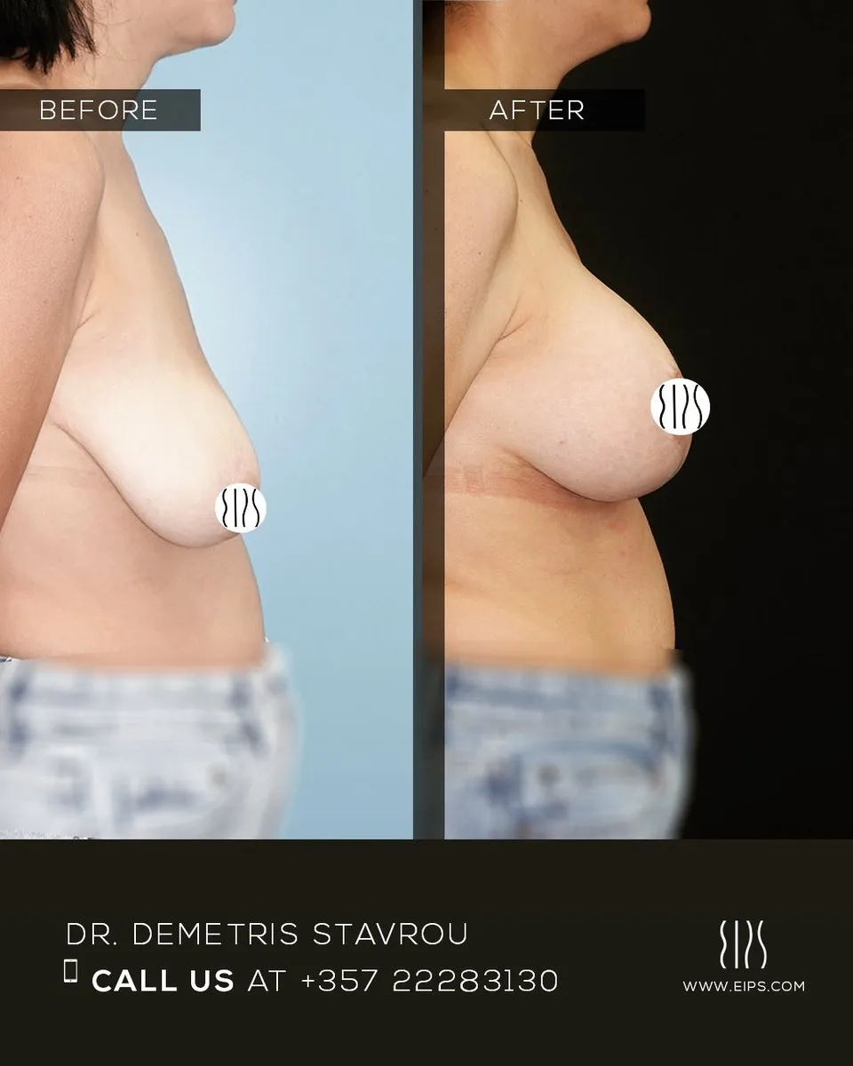 Breast Lift (Mastopexy) before and after