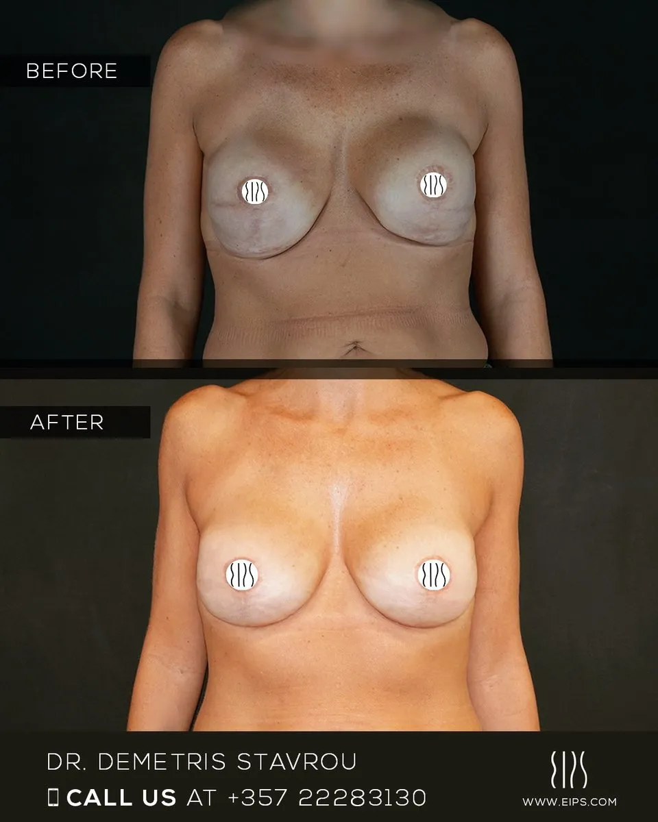 Breast Reconstruction before and after