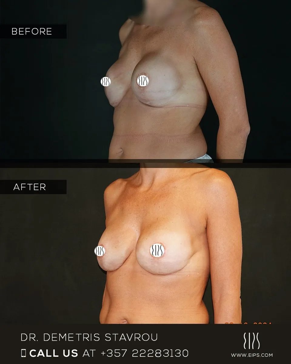 Breast Reconstruction before and after