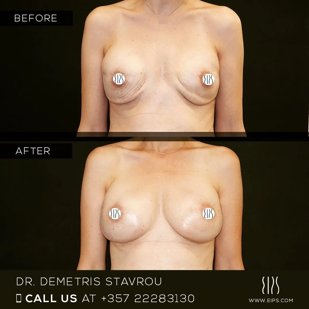 Breast Reconstruction before and after