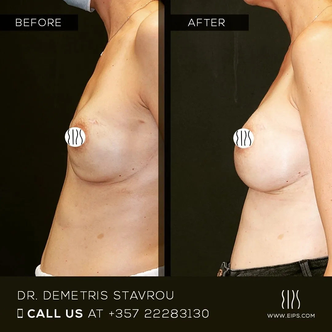 Breast Reconstruction before and after
