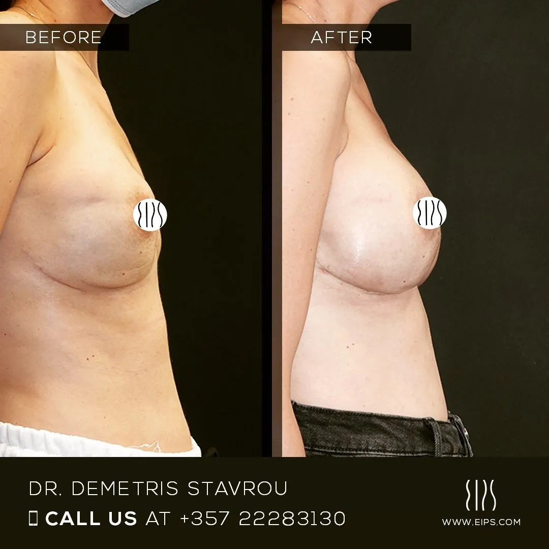 Breast Reconstruction before and after