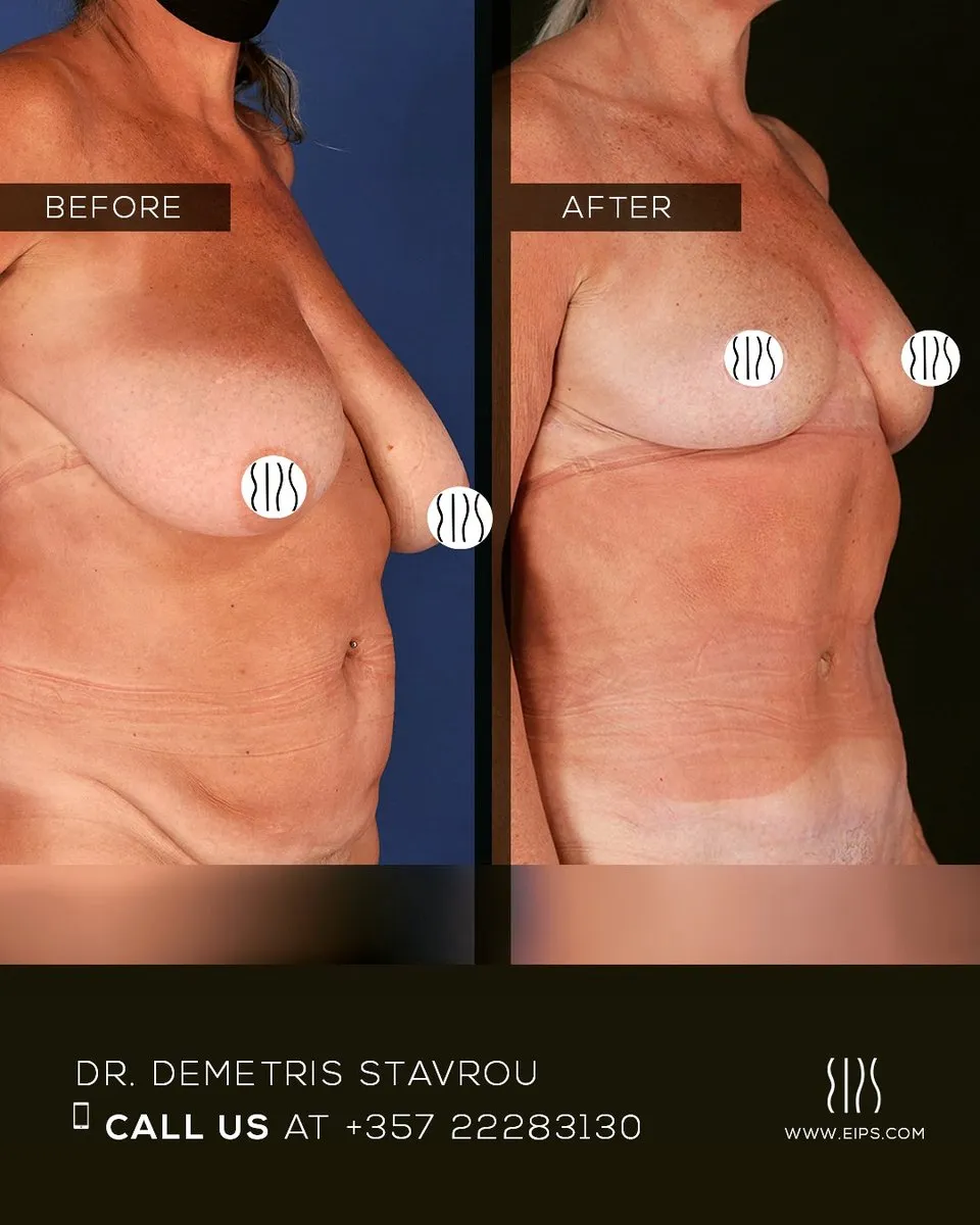 Breast Reduction before and after
