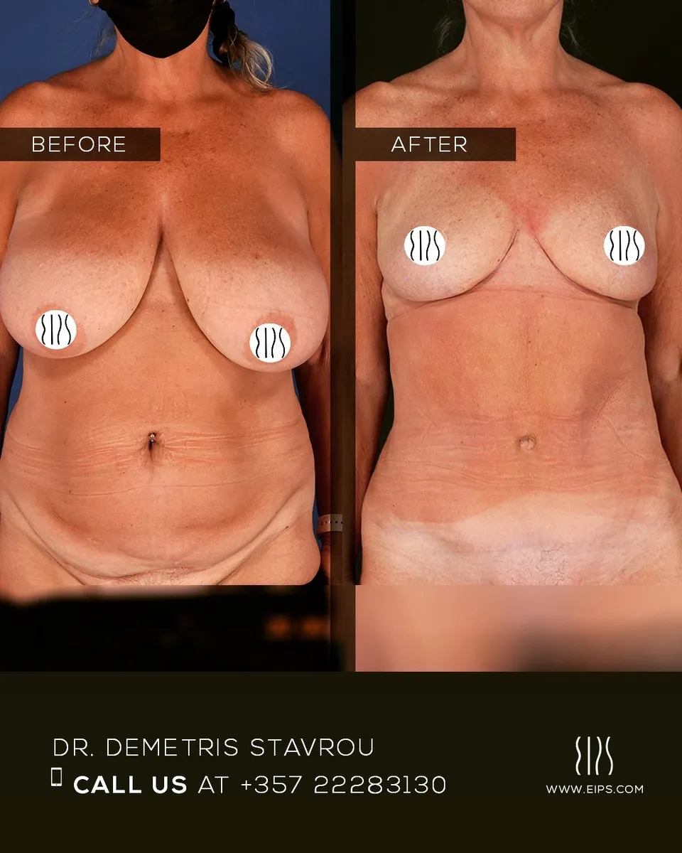 Breast Reduction before and after