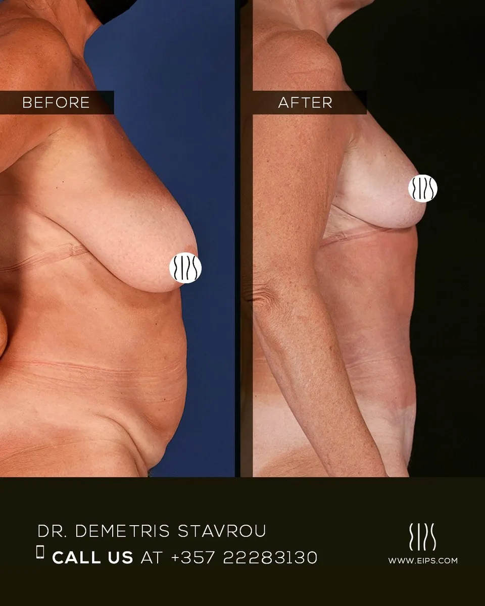 Breast Reduction before and after