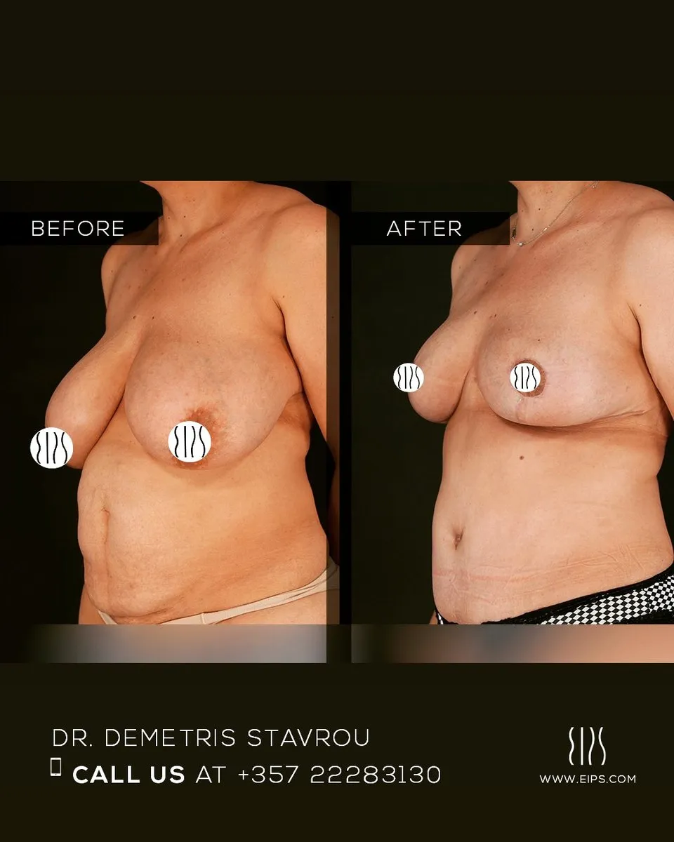 Breast Reduction before and after
