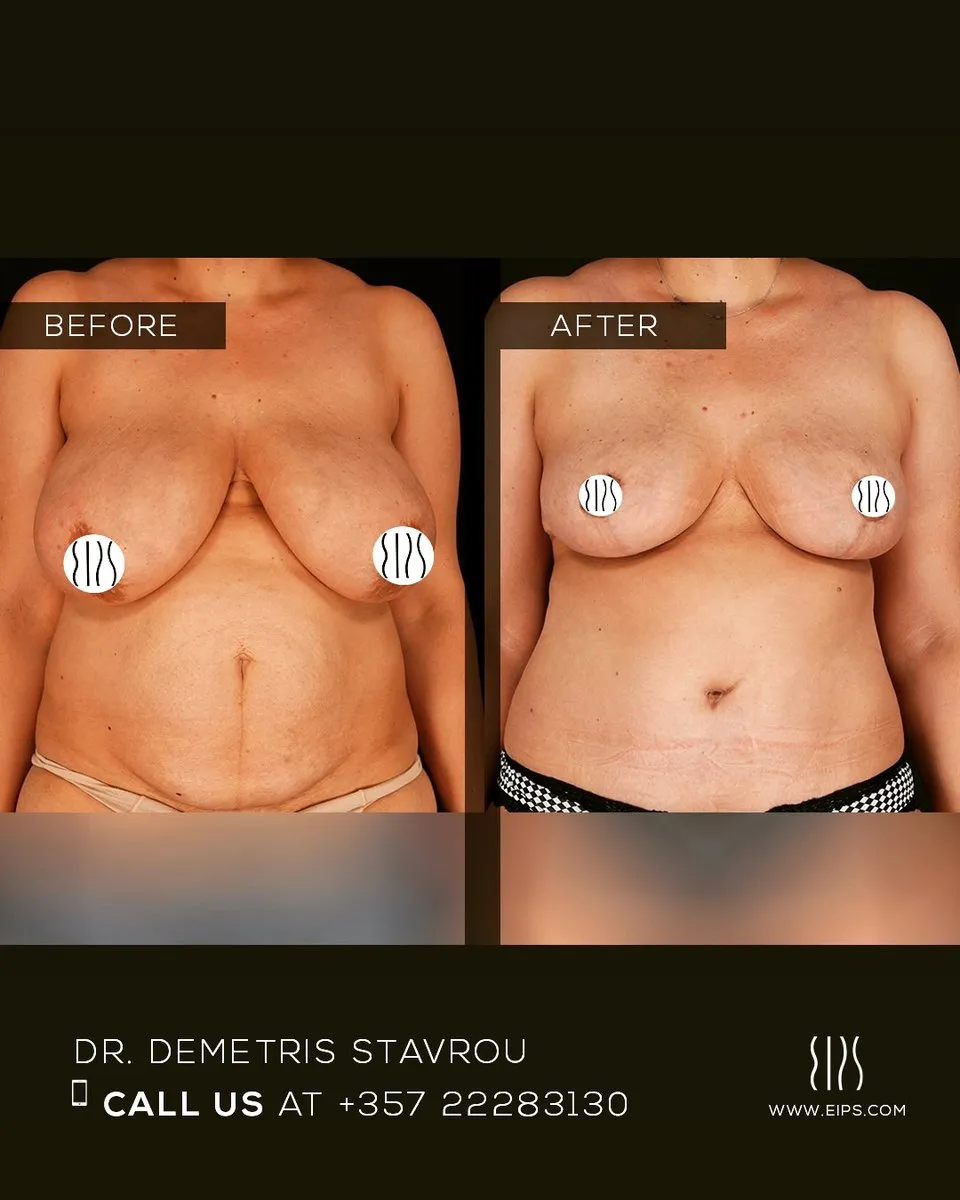 Breast Reduction before and after