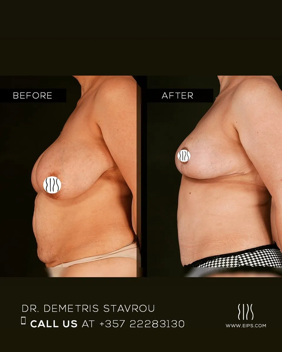 Breast Reduction before and after