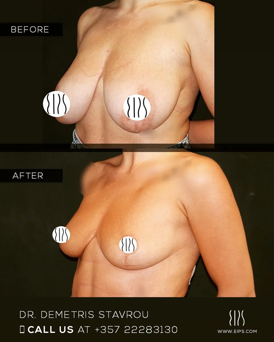Breast Reduction before and after