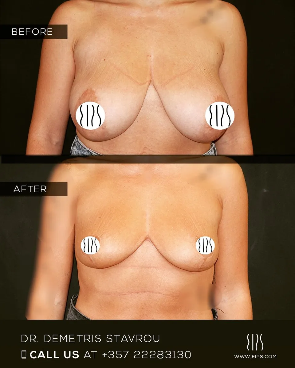 Breast Reduction before and after
