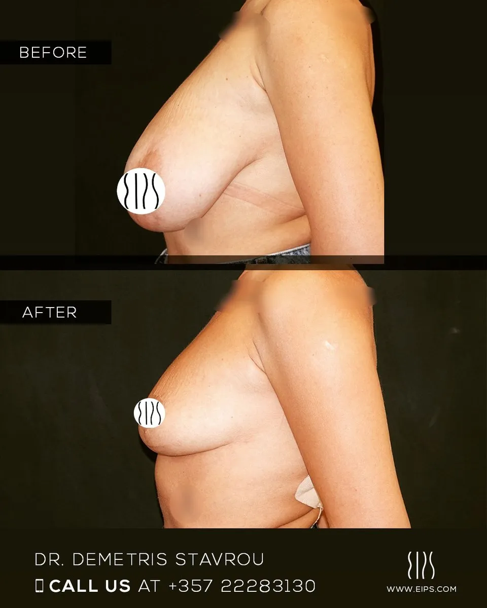 Breast Reduction before and after