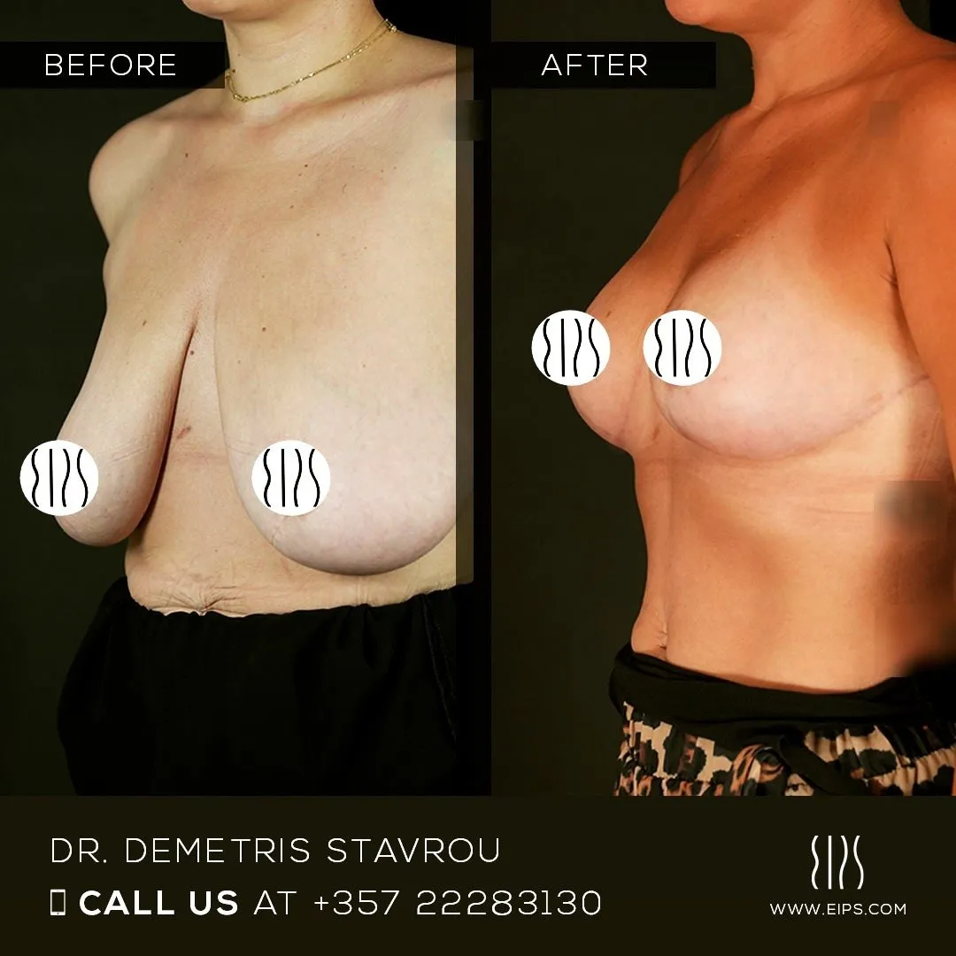 Breast Reduction before and after