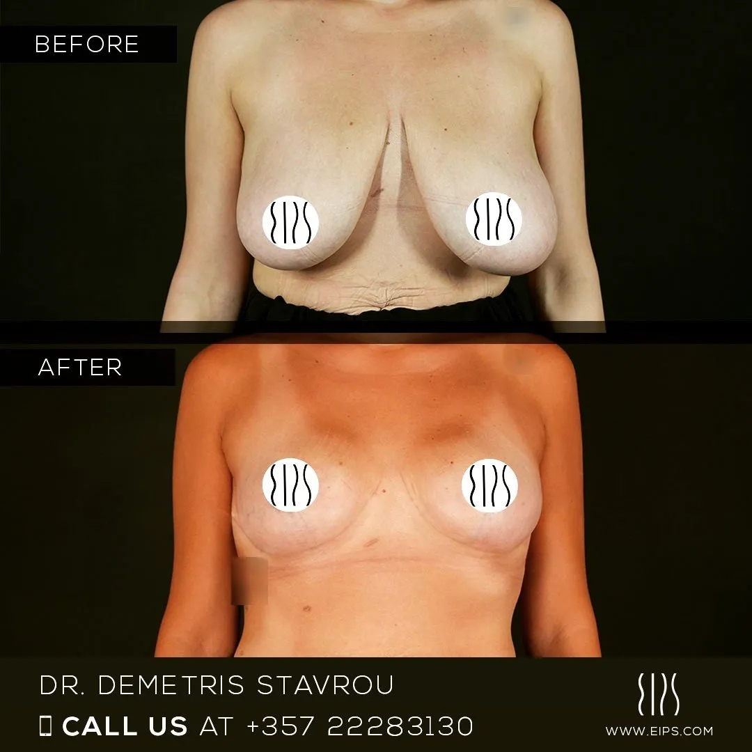 Breast Reduction before and after