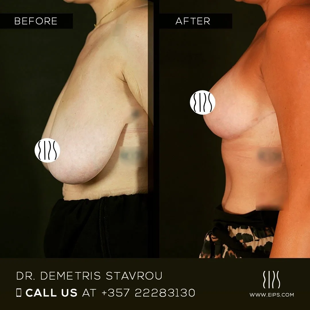 Breast Reduction before and after
