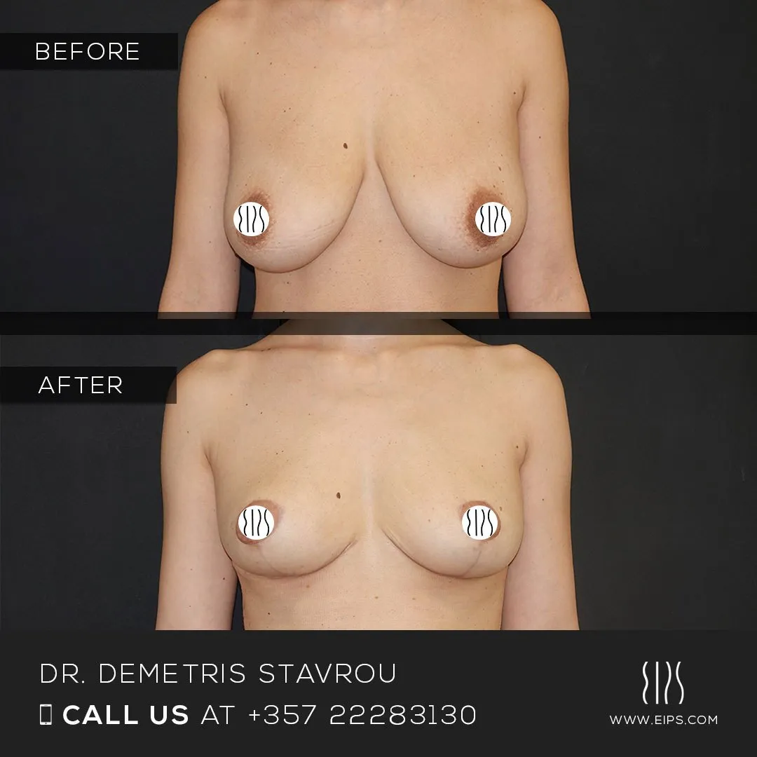 Breast Reduction before and after