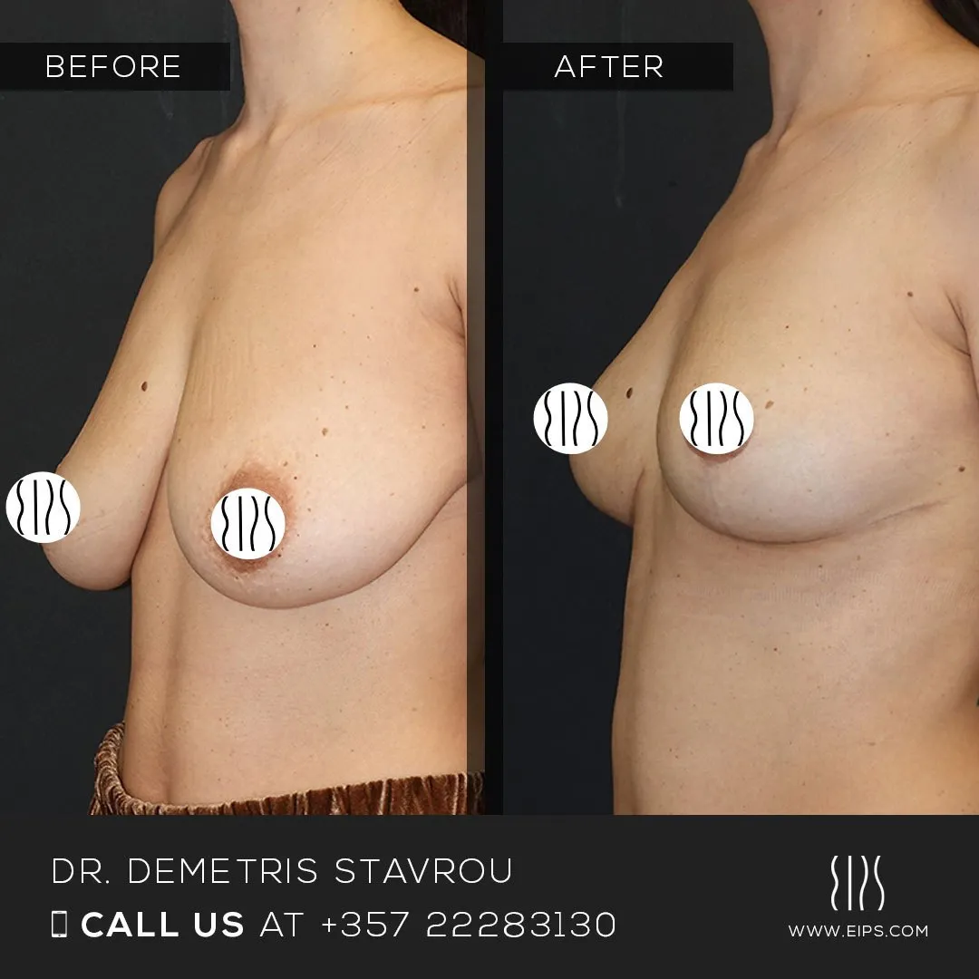 Breast Reduction before and after